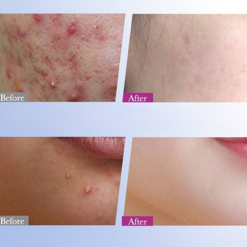 7/10/14Pcs Colorful Star Acne  - مراجعة Skincare Qv وسعره