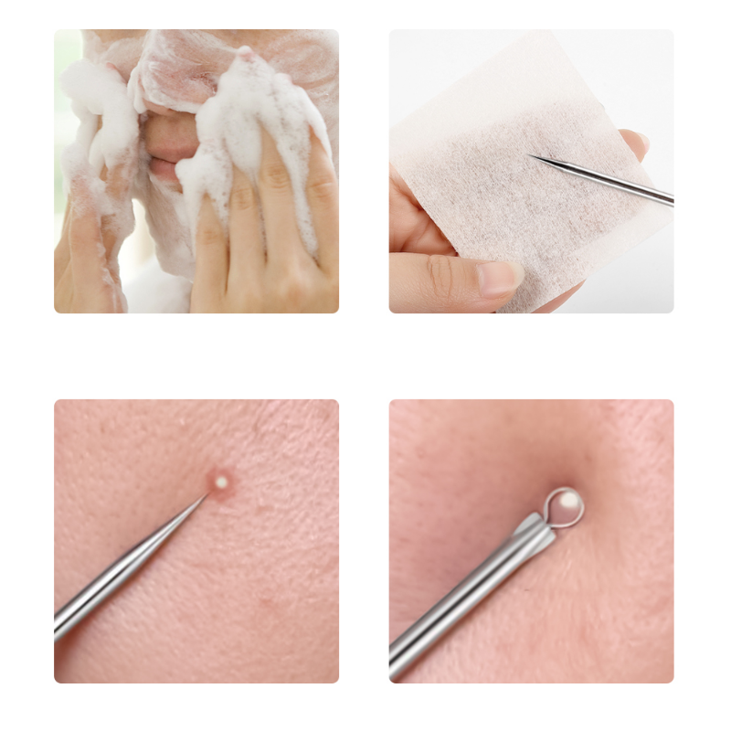 4pcs/set Acne Removal Needles  - مراجعة Skincare Qv وسعره