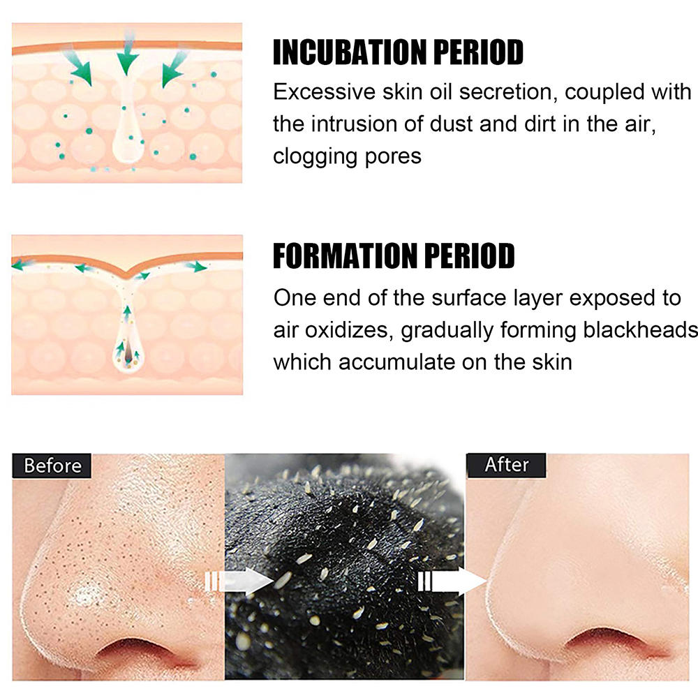 10PCS Unisex Blackhead Remove  - مراجعة Skincare Qv وسعره