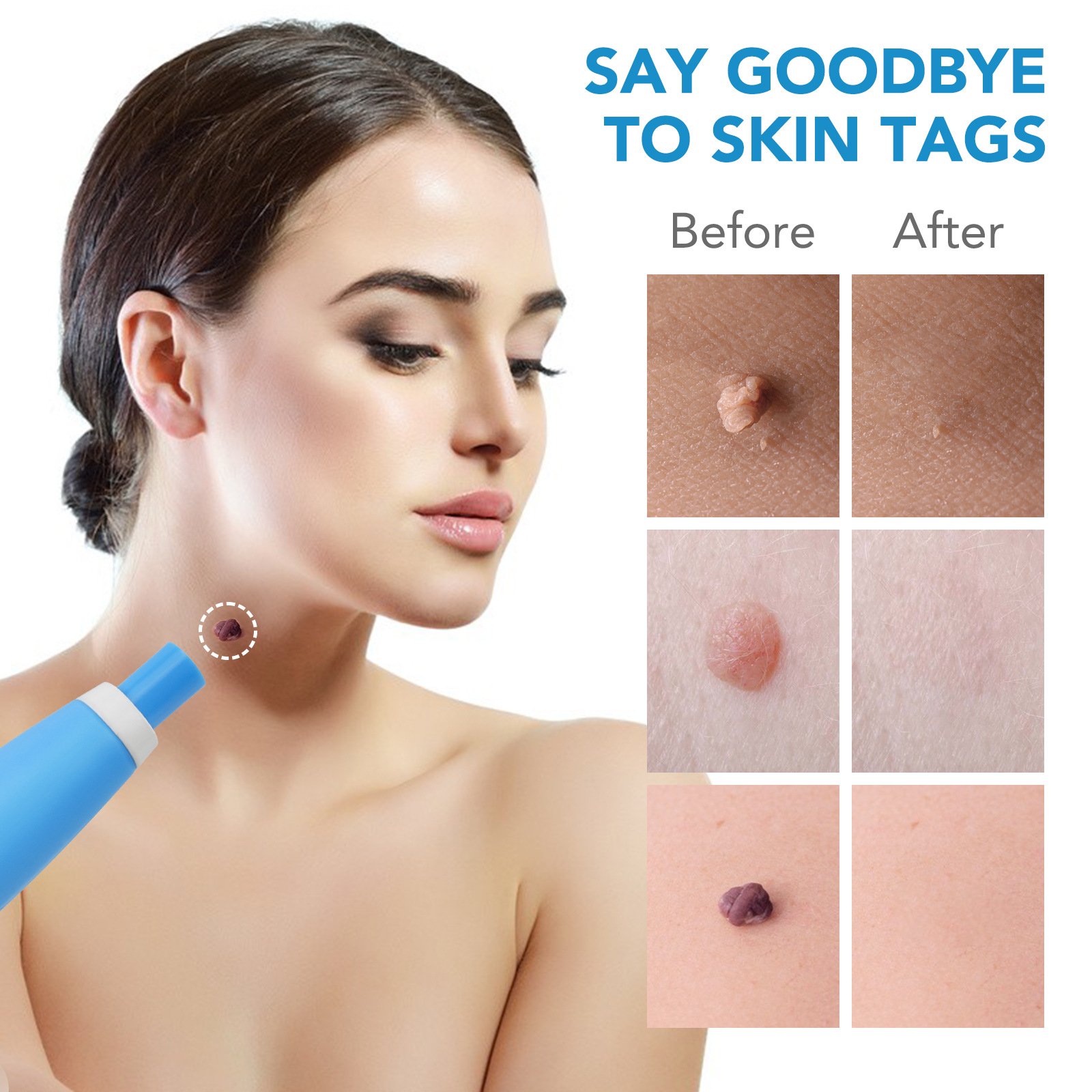 2 IN 1 Auto Skin Tag Remover K - مراجعة Skincare Qv وسعره